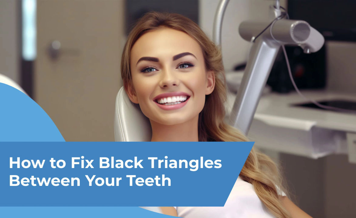 How to Fix Black Triangles Between Your Teeth