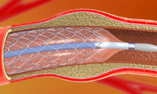 ANGIOPLASTIA PERIFÉRICA