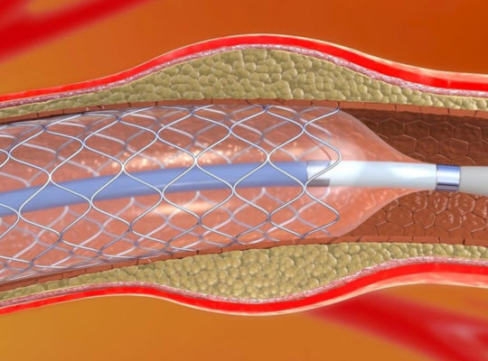 ANGIOPLASTIA PERIFÉRICA