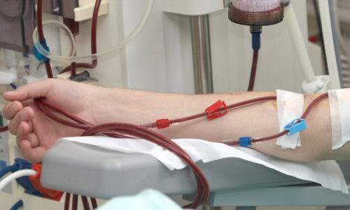 ACESSO VASCULAR - HEMODIÁLISE