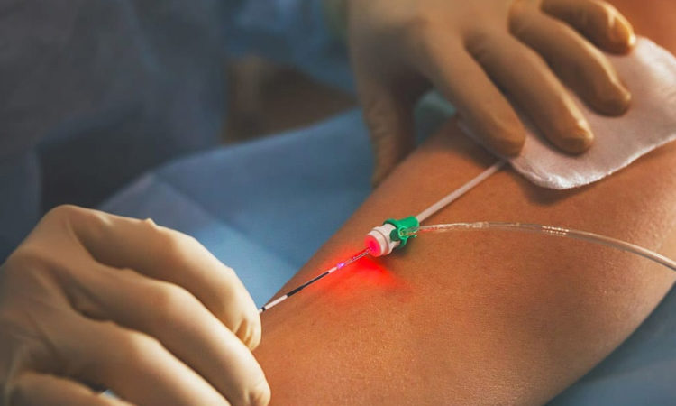 LASER - TRATAMENTO DE VARIZES