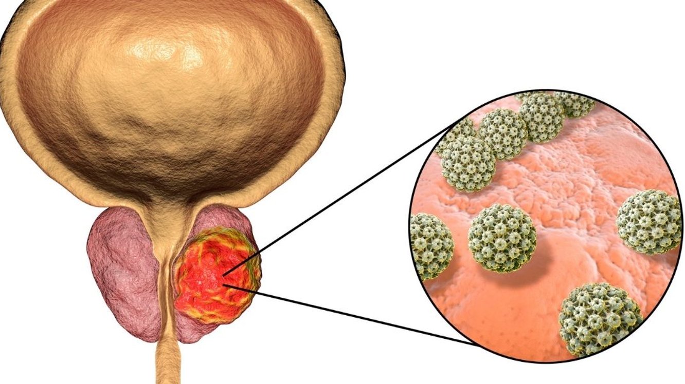 Cancer de prostată – Cauze. Simptome. Tratament