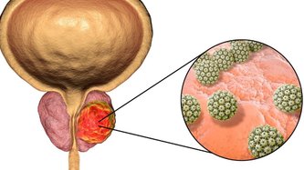 Cancer de prostată – Cauze. Simptome. Tratament