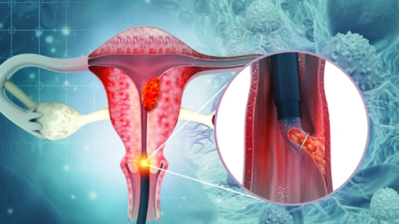Cancerul de Col Uterin