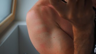 Cancerul de piele: simptome, diagnostic și tratamente	