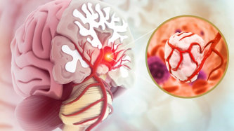 Cum diferențiem o tumoră cerebrală benignă de una malignă?