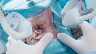 Ce Este Operația de Corectare a Vederii cu Laser (LASIK)?