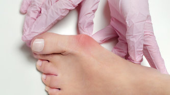 Hallux Valgus: Ce este, intervenția chirurgicală, viața după operație