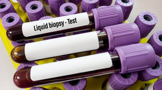 Ce este biopsia lichidă? Cum se efectuează biopsia lichidă?