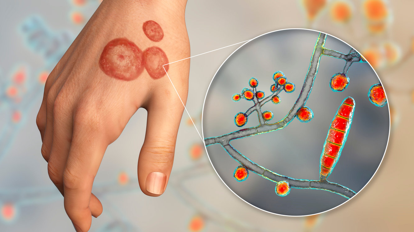 Modalități de Prevenire a Infecțiilor Fungice