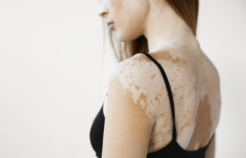 Melanin Nedir? Melanin Eksikliği Neden Olur?