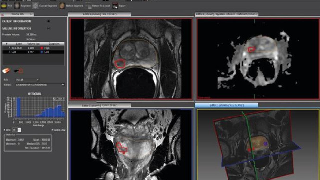 MR-TRUS FUSION: biopsie tratament cancer prostata