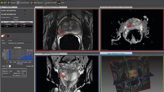 MR-TRUS FUSION: biopsie tratament cancer prostata