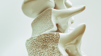 Osteoporoz (Kemik Erimesi)? Belirtileri, Nedenleri ve Tedavisi