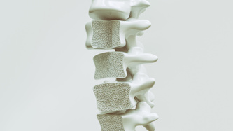 Osteoporoz nedir? Nasıl tedavi edilir?