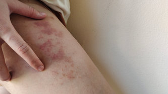 Ce este purpura?