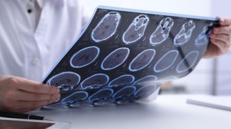 Scleroza în plăci – Cauze. Simptome. Tratament
