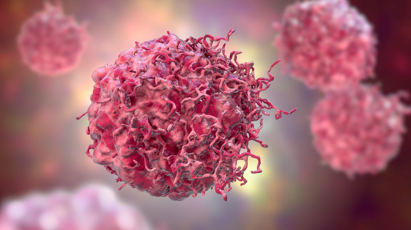 Cancerul de Țesuturi Moi (Sarkom): Ce Este, Simptome, Tipuri și Tratament