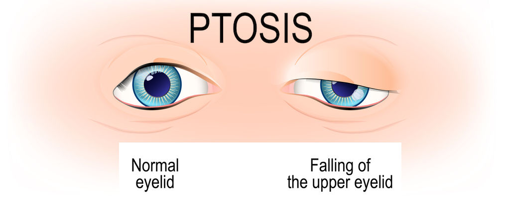 kelopak mata ptosis
