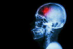 "Stroke" (cerebrovascular accident). Film x-ray skull lateral with stroke and blank area at left side