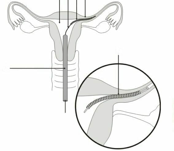 Essure Birth Control Device Defects Prompt Lawsuits From Medical Complications