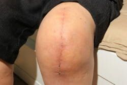 Zimmer Persona Trabecular Metal Tibial Plate Knee Implant Lawsuits - South Carolina