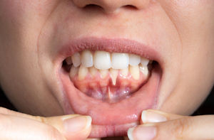 Gum disease