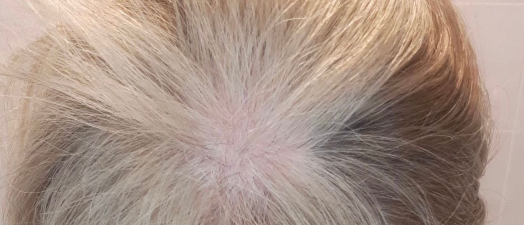 Hair Restoration | Treatment | Galway Skin Clinic Hair Restoration | Treatment | Galway Skin Clinic