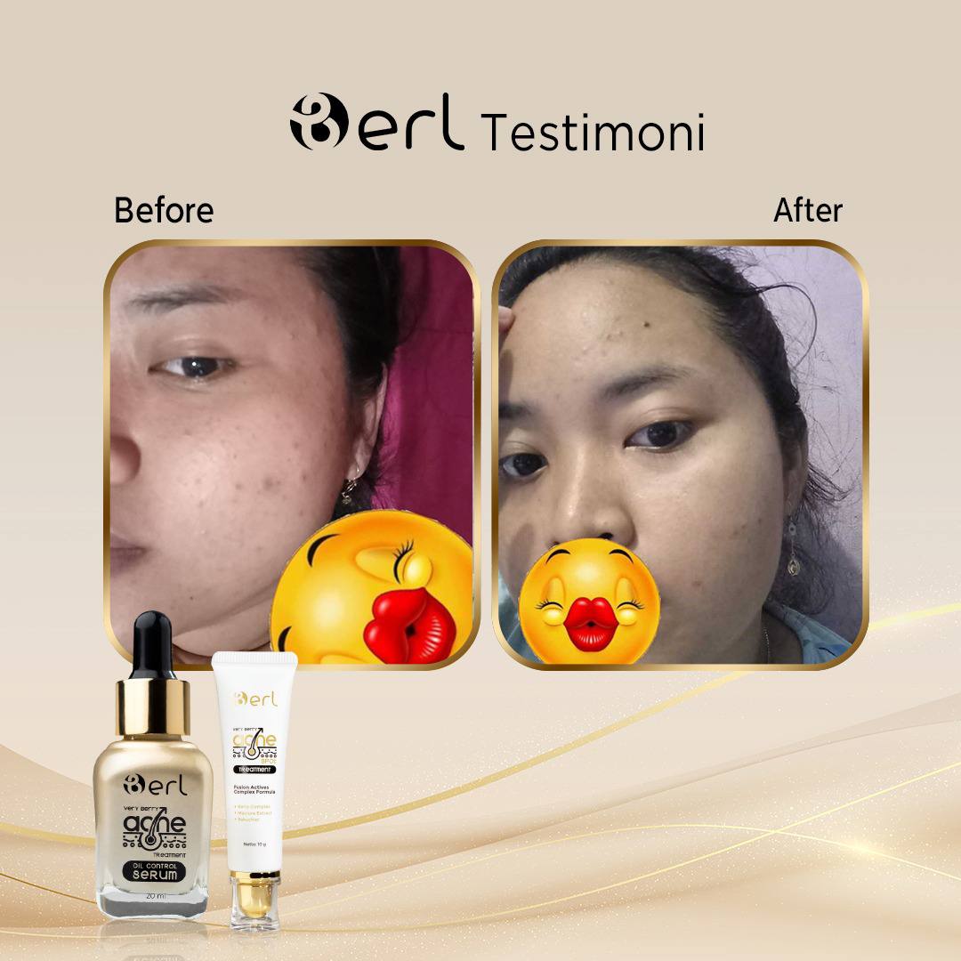 Testimoni B Erl Very Berry Acne Spot Treatment