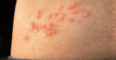 Doctor in the House: What You Should Know About Shingles 