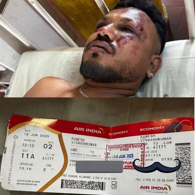Ramesh Vishwaskumar - Lone Survivor in Ahmedabad Plane Crash