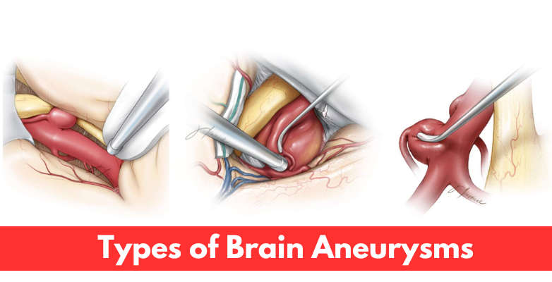 Salman Khan Brain Aneurysm Revelation Sparks Concern – What It Means And How Dangerous It Can Be 2 Types of Brain Aneurysms