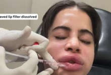 Uorfi Javed lip filler dissolved