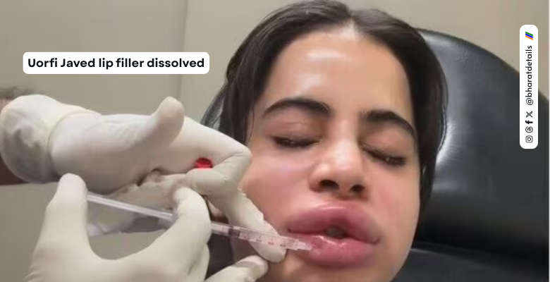 Uorfi Javed Lip Filler Dissolved Experience Sparks Debate on Cosmetic Procedures 1 Uorfi Javed lip filler dissolved