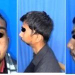 एम्स गोरखपुर में बर्ड फेस डिफॉर्मिटी से पीड़ित युवक