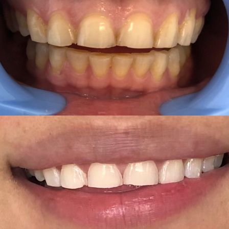 Spray Tans & Bright Smiles: Mobile or In-Office Magic image 6