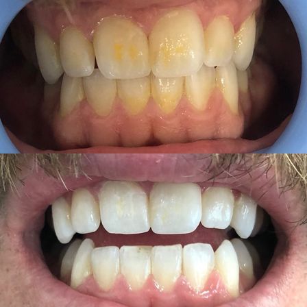 Spray Tans & Bright Smiles: Mobile or In-Office Magic image 7