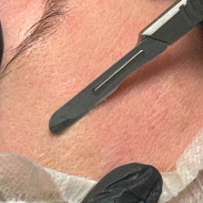 Dermaplaning