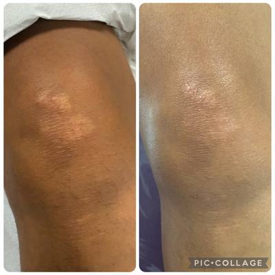 Microneedling - scar reduction
