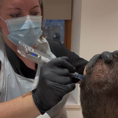 Microneedling - Hair restoration