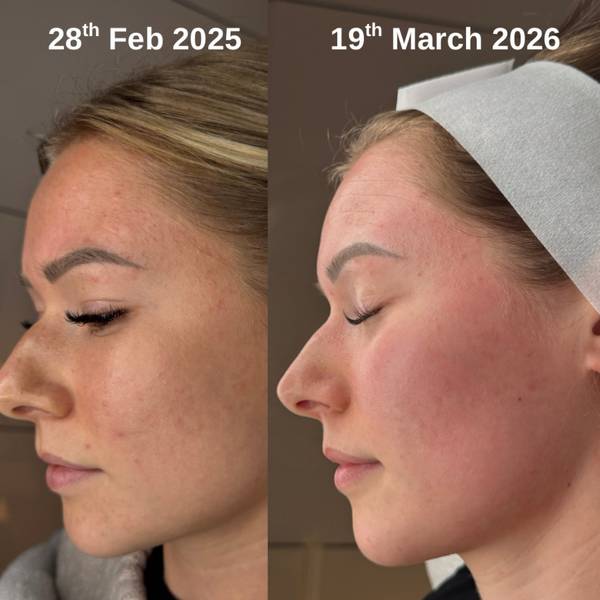 Microneedling 👏🏼