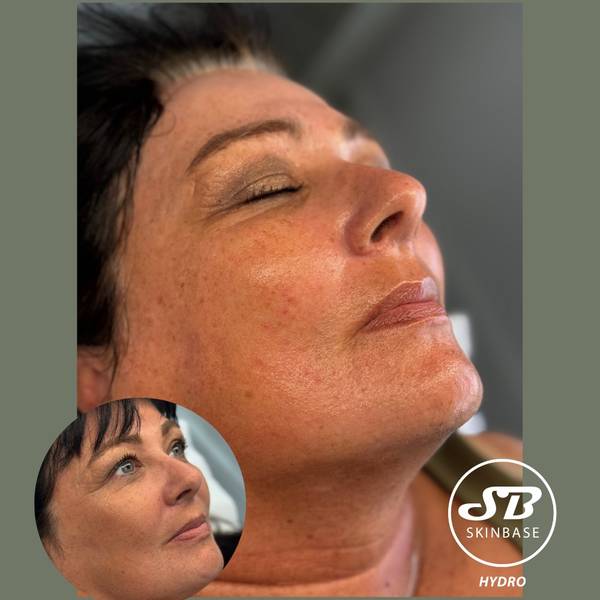 Hydrofacial -Renewing serum