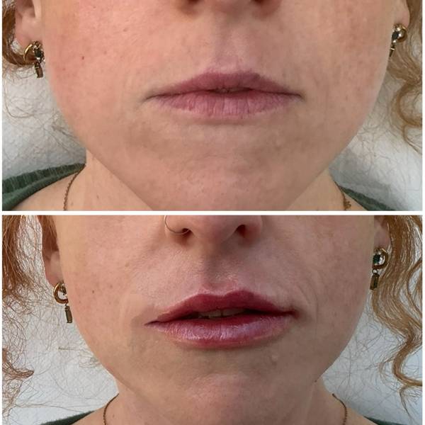 Lip filler after dissolving 