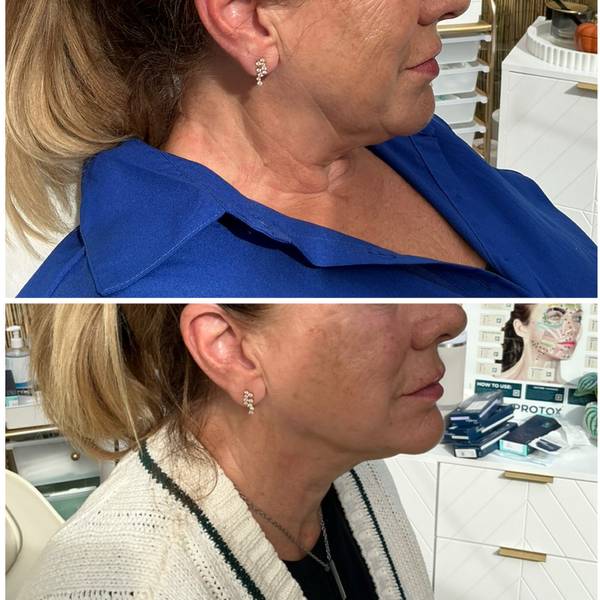 Cheek and jawline filler