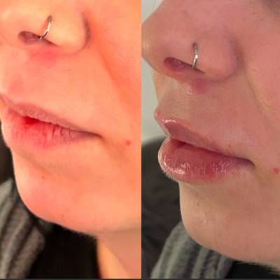 0.7mls lip filler