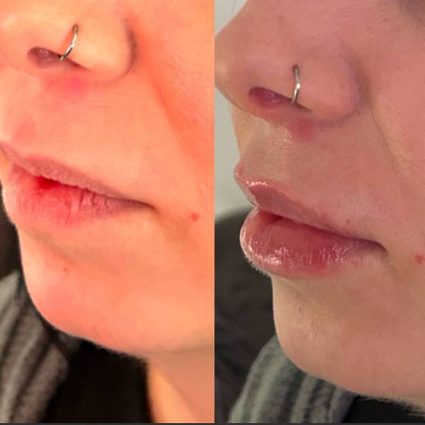0.7mls lip filler