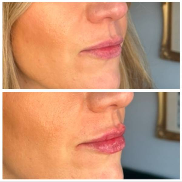 0.8mls lip filler
