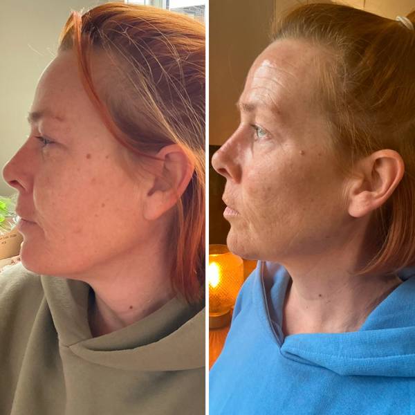 Cheek, chin and jawline filler 
