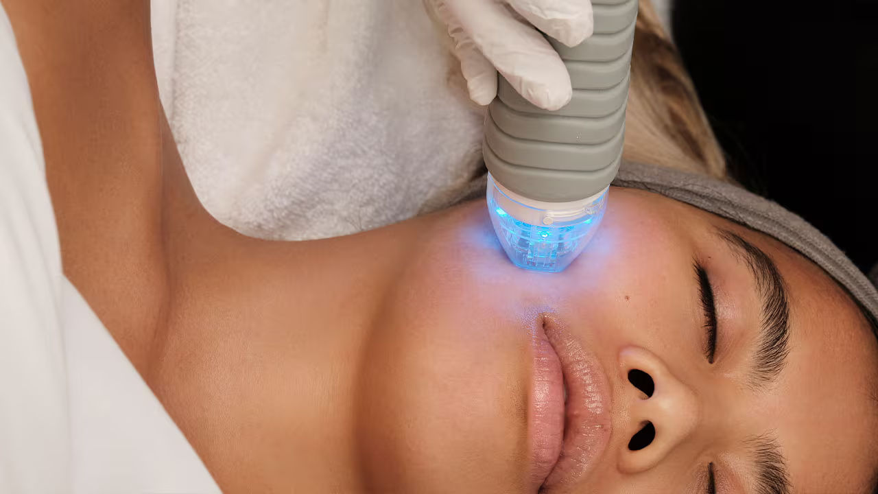 Vivace RF Microneedling device used at Beyond The Face Tunbridge Wells