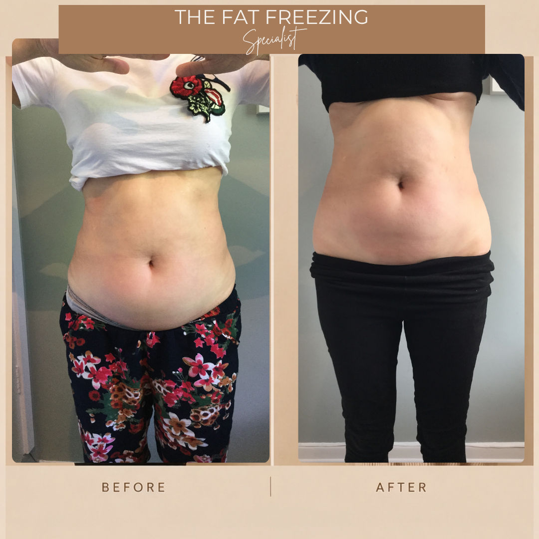 Before and after fat freezing on the abdomen, front view